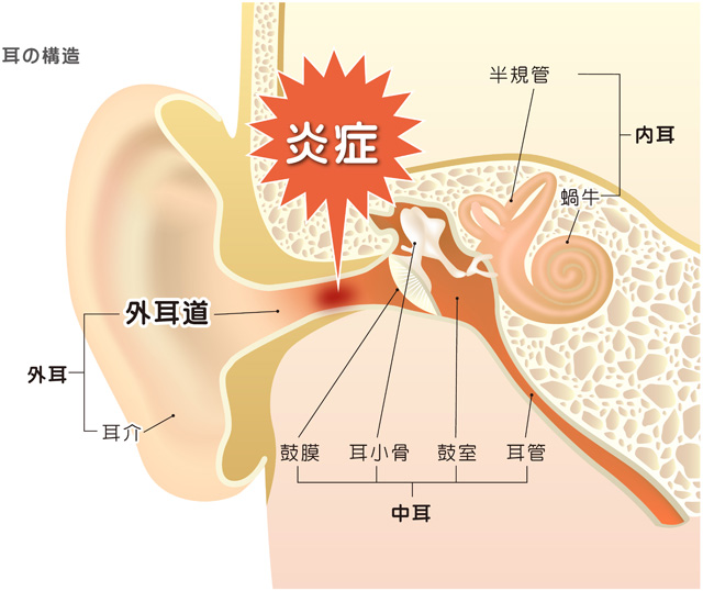 【外耳道炎】